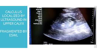 ULTRASOUND GUIDED ESWL FOR RENAL CALCULI [upl. by Adnahs128]