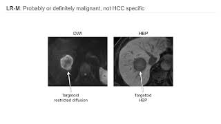 Imaging HCC and LIRADS [upl. by Aridatha]