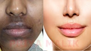 How To Remove Dark Black patches Dark SpotsHyper pigmentation Around Your Mouth  PRIYA MALIK [upl. by Yauqram]