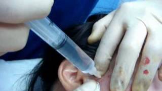 Prolotherapy TMJ by a Musculoskeletal Physician肌骼科醫生示範顳下頜關節的保絡治療 [upl. by Sinai]