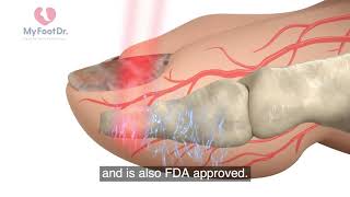 Lunula Laser Treatment with My FootDr Singapore  English subtitles [upl. by Clougher184]