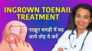 Ingrown Toenail Treatment in Hindi  Home Remedy Using Dental Floss Cotton [upl. by Ramonda]