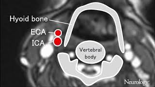 Swallowinginduced displacement of the carotid artery as a risk of stroke Flipflop phenomenon [upl. by Ahsiela]