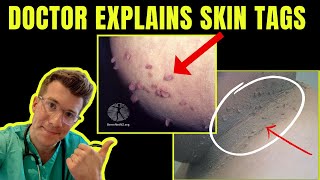 Doctor explains SKIN TAGS  including CLINICAL PHOTOS CAUSES amp TREATMENT [upl. by Petuu]