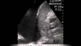 VSCAN Constrictive pericarditis Pocket Ultrasound Pericarditis constrictiva ECO DE BOLSILLO [upl. by Nob991]