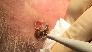 Removal of Seborrhoeic Wart [upl. by Topper514]