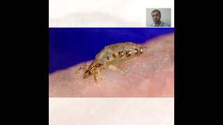 Body Lice Treatment  Symptoms and Causes  Diagnosis  Prevention health [upl. by Ahseel139]