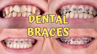 Braces time lapse  Teeth braces treatment  braces teeth transformation [upl. by Volnay]