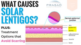 Causes and Treatments for Solar Lentigos [upl. by Cristina]