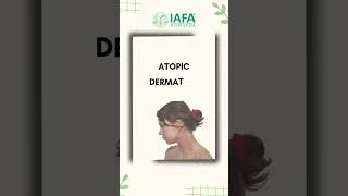 Atopic Dermatitis  Ayurvedic Treatment Herbs and Diet shorts [upl. by Thom]