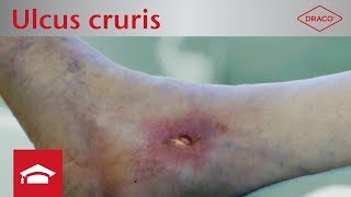 Ulcus cruris venosum und arteriosum Definition Entstehung amp Wundbeschreibung [upl. by Ecnav]