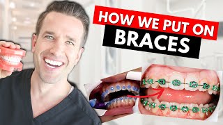 How Braces are Put On  Part IV Dr Nate [upl. by Dalia331]