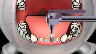 Optimal Implantation with a Torque Ratchet [upl. by Akemor]