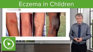 Eczema in Children – Pediatrics  Lecturio [upl. by Ayekehs780]