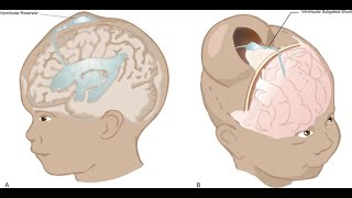 Intraventricular hemorrhage IVH of the newborn [upl. by Kaczer]