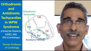 Orthodromic and Antidromic Tachycardias in WPW Syndrome [upl. by Yeldah]