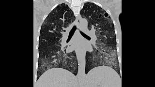 PCP Pneumonia por pneumocystis Jirovecii [upl. by Greyso7]