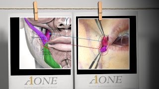 How to perform Smile Lipt Mouth corner lifting procedure and its effectiveness [upl. by Engenia570]