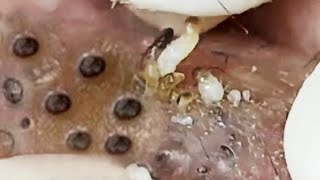 Blackheads amp Whiteheads Satisfying Removal 0257 [upl. by Noislla434]