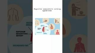 Superior mesenteric artery syndrome kattrucate medicalreels superior artery syndrome exercise [upl. by Dorene]