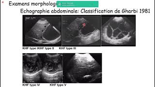 Gastro 16Kyste hydatique du foie KHF Dr Boudiaf [upl. by Preston]