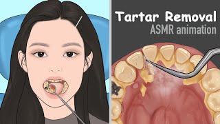 ASMR Tartar removal animation  Dental Scaling  Satisfying [upl. by Sholem581]