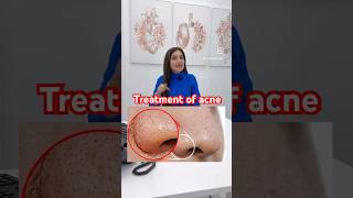 Treatment of acne and white head nose  skincare  skin therapy darkspots ​⁠DrMigraine [upl. by Neeneg]