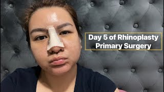 Day 5 Rhinoplasty Primary Surgery by DrJohn Levi Lansangan of Dr Shimmian Aesthetic Center [upl. by Eseneg]