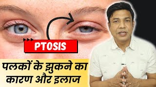 Ptosis of the Eye What You Need to Know Don’t Miss Out🔥 [upl. by Noskcaj728]