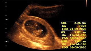 Inside 9 Weeks Pregnancy  Fetal Development and Ultrasound Insights [upl. by Aihsot483]