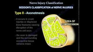 Nerve Injury types  Nerve recovery  Everything You Need To Know  Dr Nabil Ebraheim [upl. by Mavra430]