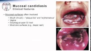 Candida Mucosal candidiasis [upl. by Tama225]