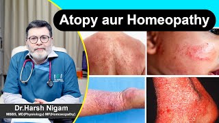 Atopy aur Homeopathy atopy [upl. by Oates833]