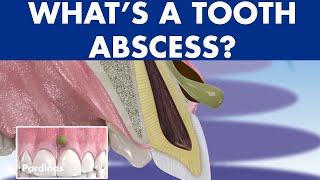 TOOTH ABSCESS dental infection  PHLEGMON symptoms and treatment © [upl. by Mharba570]