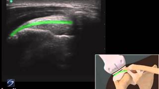 Démo 3D  échographie dune tendinite de la coiffe des rotateurs  Échographe SonoSite [upl. by Balliol]