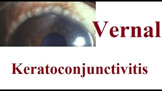 Vernal Keratoconjunctivitis VKC [upl. by Malorie65]