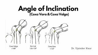 Angle of InclinationCoxa Valga and Coxa Vara [upl. by Partridge850]