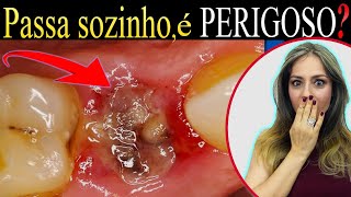 COMO RESOLVER a Alveolite Seca DOR ou Inflamação no LOCAL da Extração de Dente 74 [upl. by Gwendolyn648]