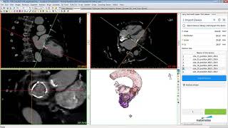 Mitral Planning Wizard in Mimics  Mimics Innovation Suite  Materialise Medical [upl. by Bronwyn]