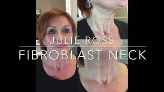 Turkey Neck Fibroblast Plasma Neck Treatment before during amp healed [upl. by Brigitte79]