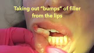 Removing “bumps” of filler from the lips [upl. by Yrennalf]