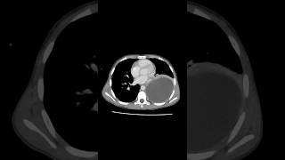 Pulmonary hydatid cyst ctchest [upl. by Bray]