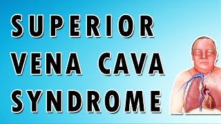 Superior Vena Cava Syndrome [upl. by Hiroshi682]