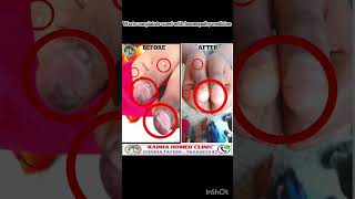 wart treatment in tamil  warts removal in tamil  maru poga tips in tamil  dr balajimuthu [upl. by Gardiner]