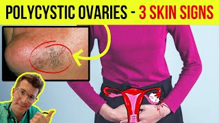 Doctor explains 3 SKIN SIGNS ASSOCIATED WITH POLYCYSTIC OVARIAN SYNDROME PCOS [upl. by Ellertnom]