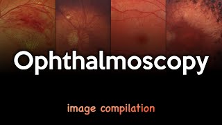 Ophthalmoscopy [upl. by Humble]