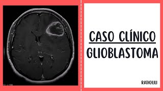 Caso Clínico 56 Glioblastoma [upl. by Darreg]