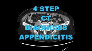 How to diagnose Acute Appendicitis on CT in 4 Steps  Radiology Medical Imaging Pearls Tips Tricks [upl. by Gut996]