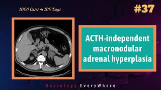 ACTHindependent macronodular adrenal hyperplasia  1000 videos in 100days  video 37 [upl. by Yssenhguahs]