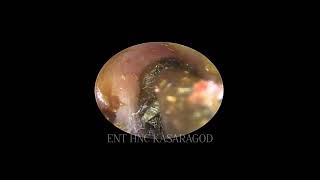 CERUMENV3 Impacted ear wax removed Endoscopic suction clearance [upl. by Aliekahs394]